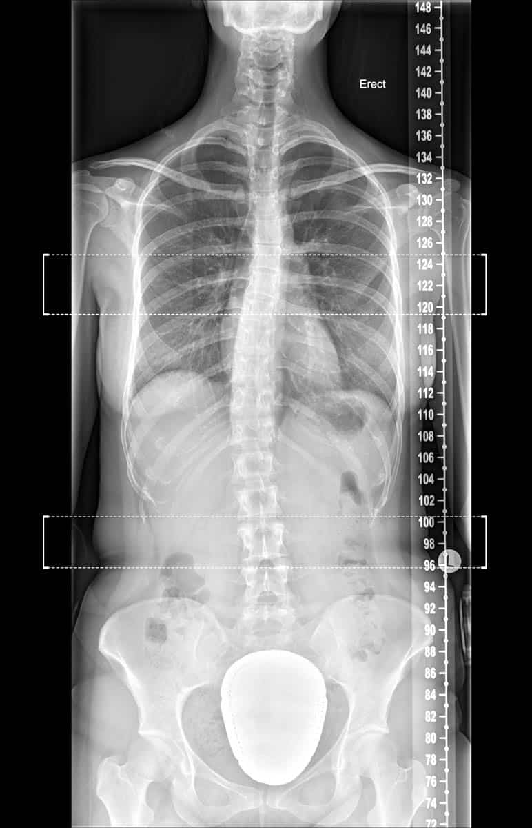 Dr. Ravi Kumar Spine Xray